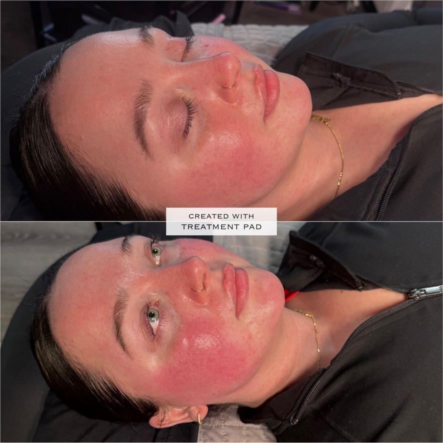 Hydrafacial before-and-after comparison from Solis