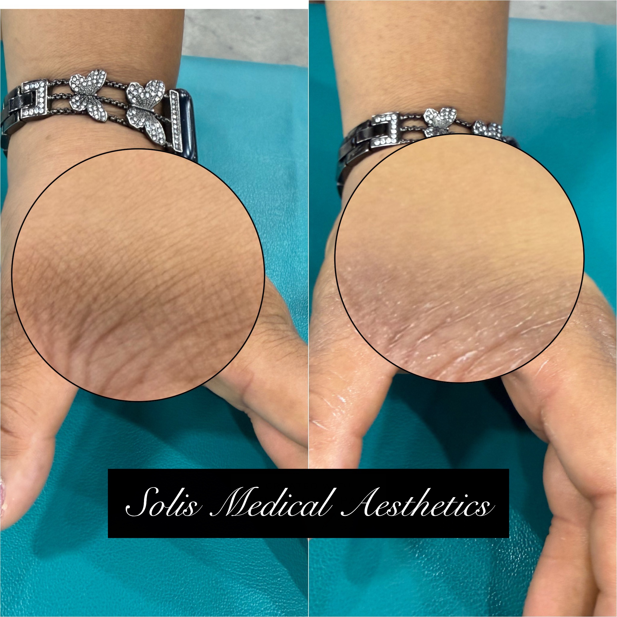 Skin lightening before-and-after comparison from Solis