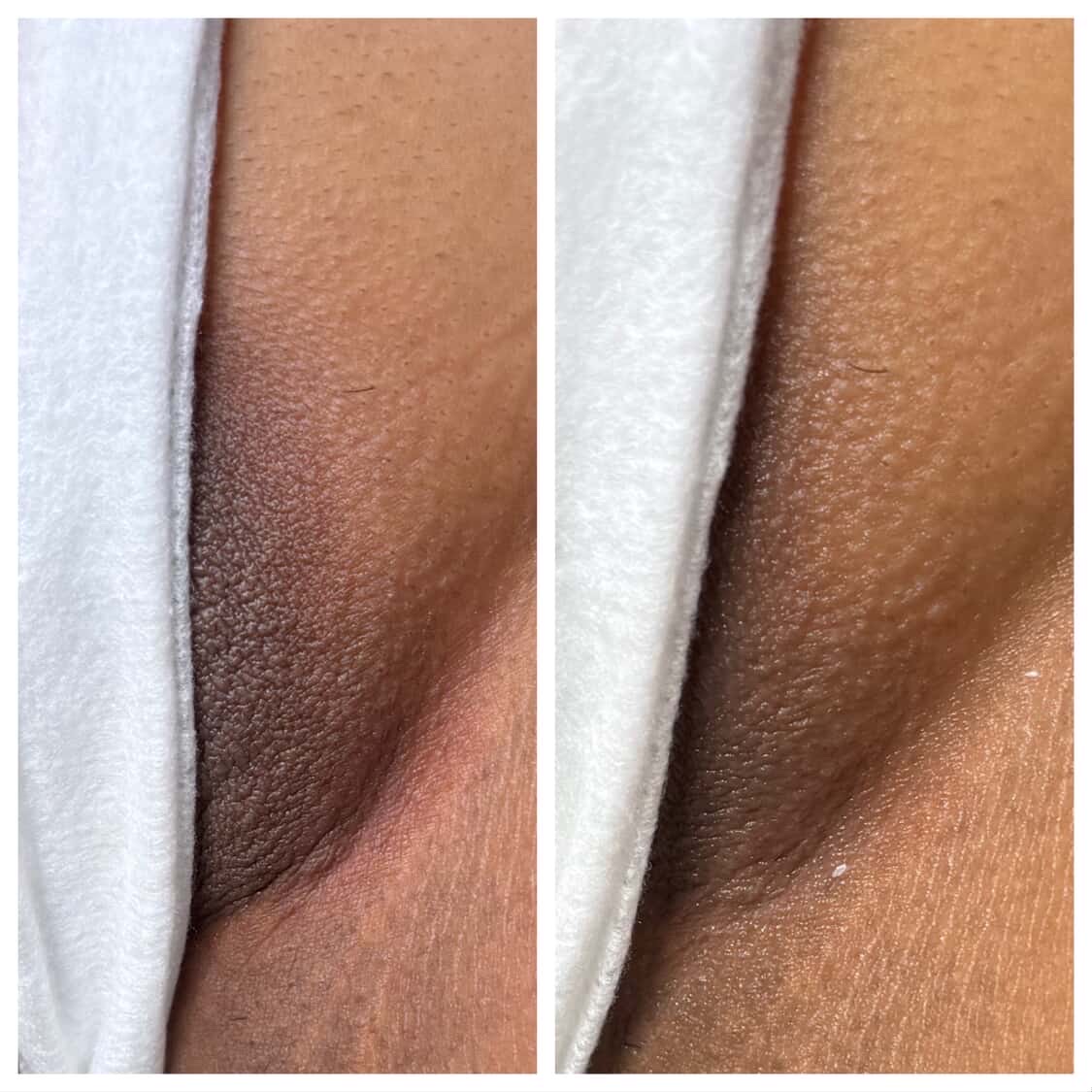 Skin lightening before-and-after comparison from Solis