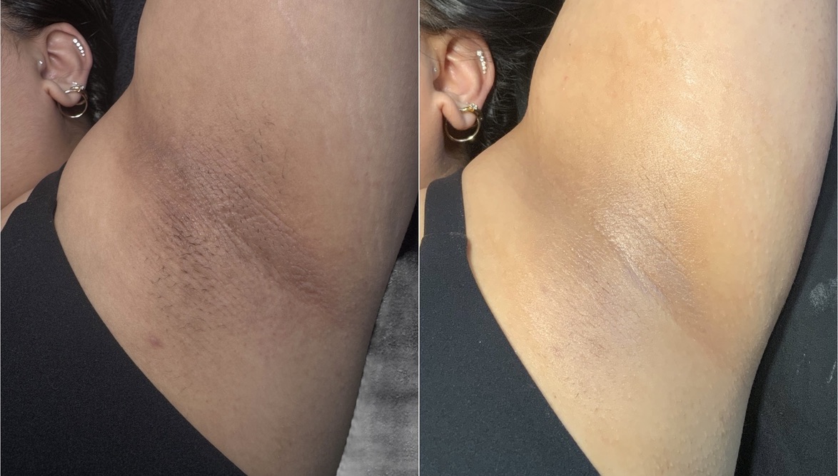 Skin lightening before-and-after comparison from Solis