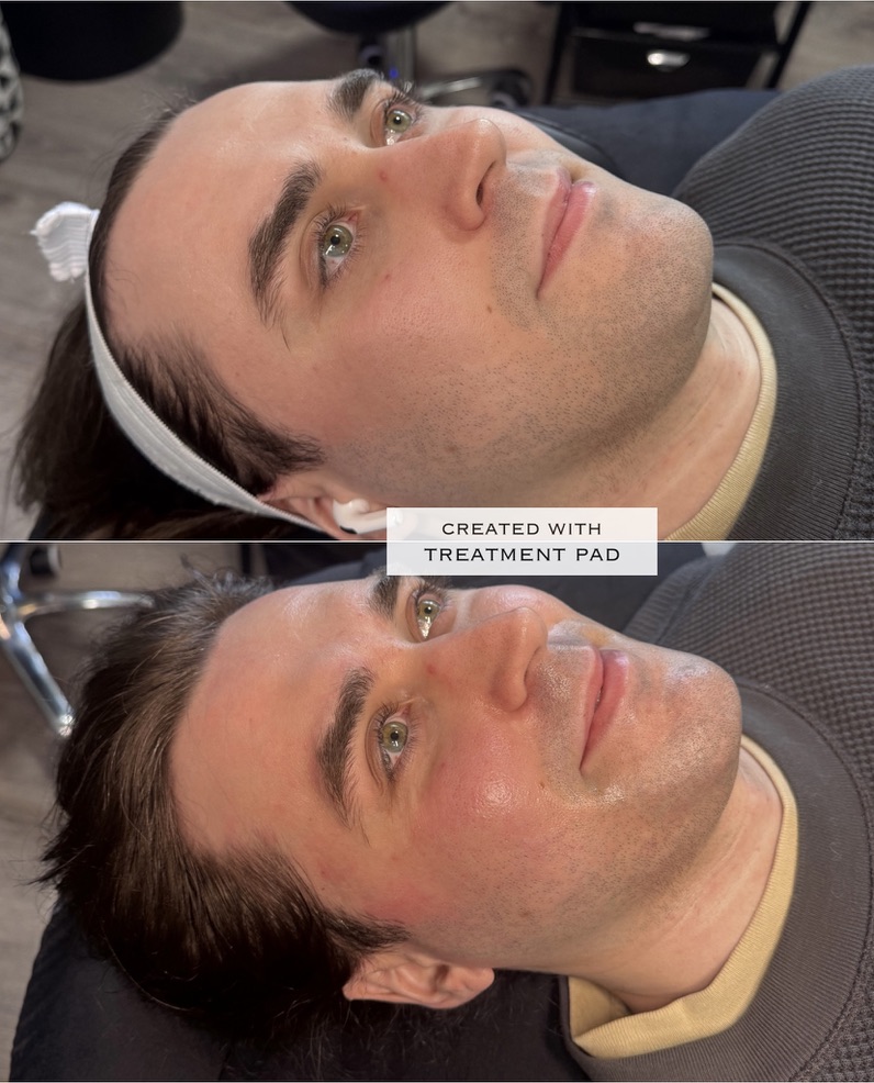 Hydrafacial before-and-after comparison from Solis