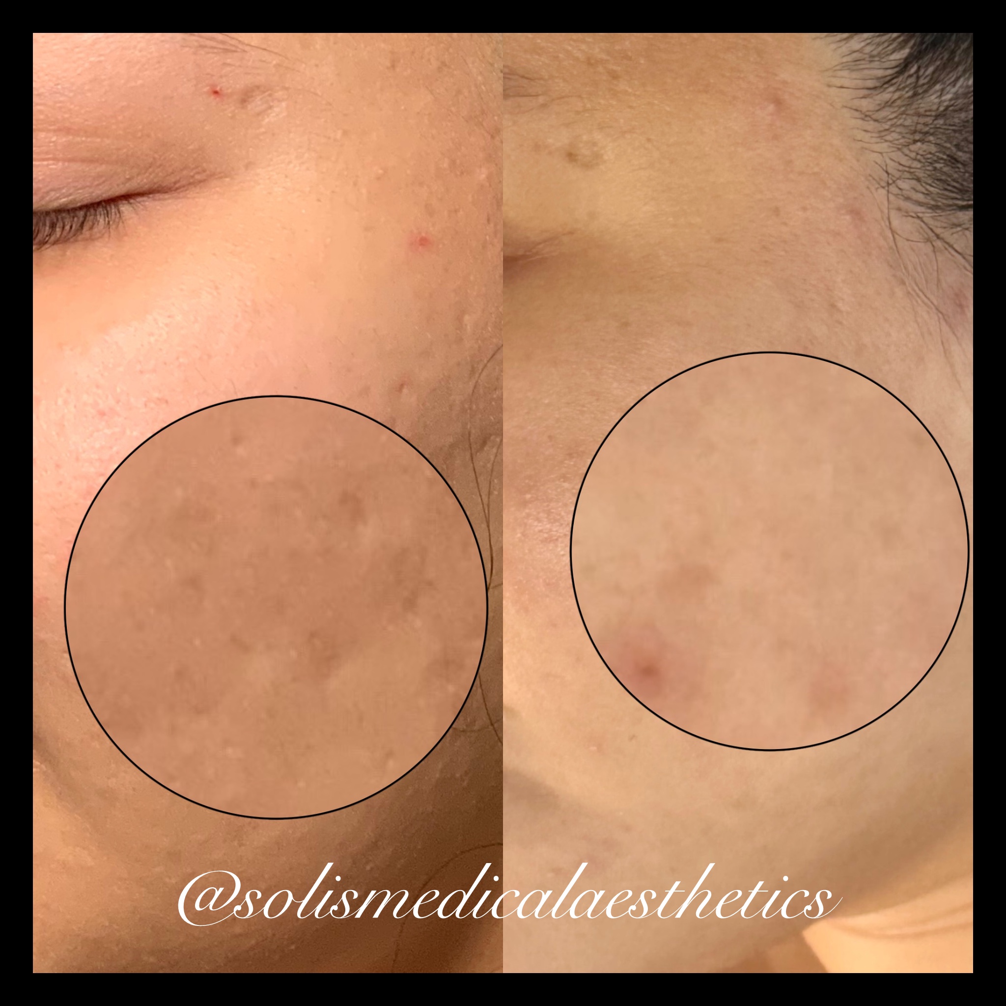 Microneedling before-and-after comparison from Solis