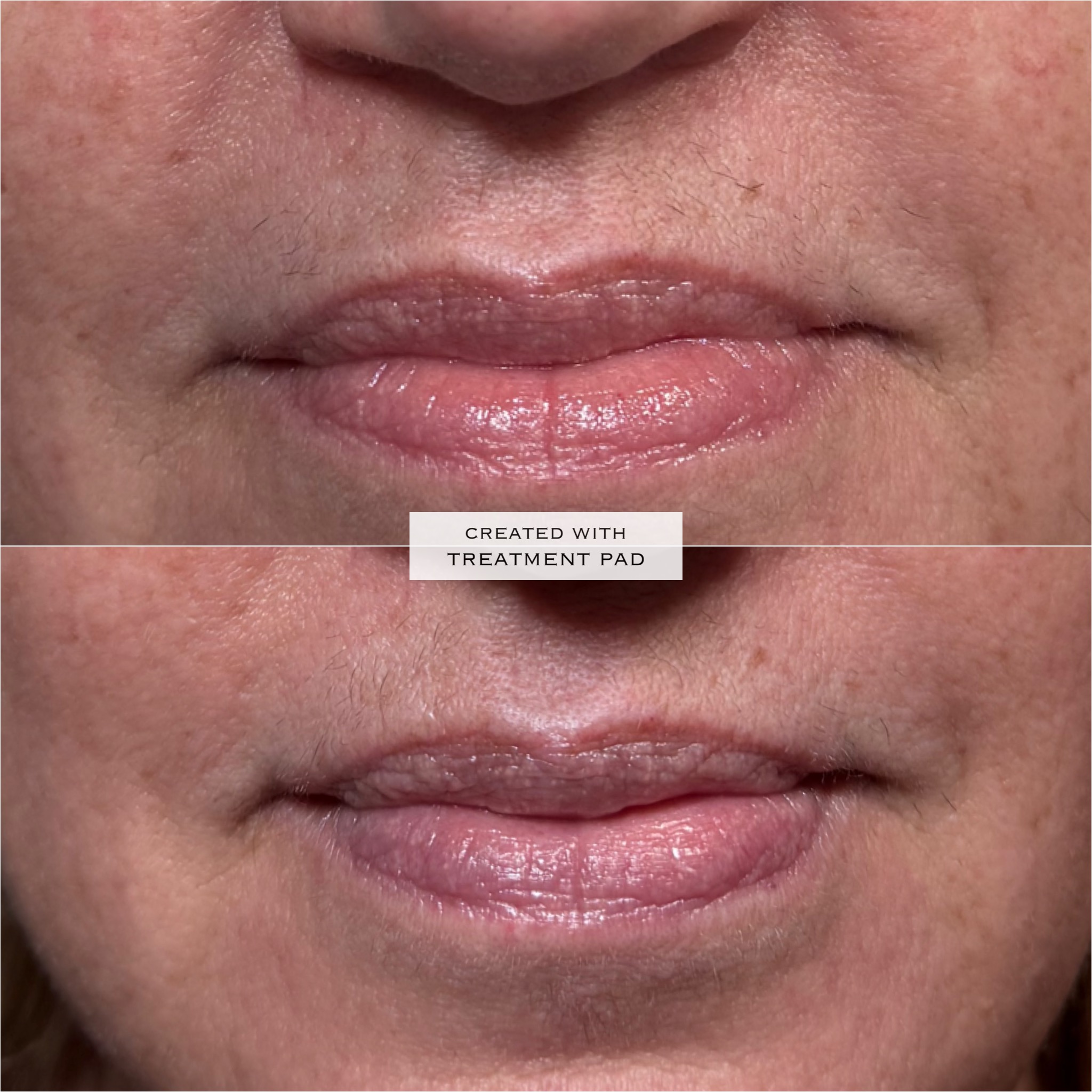 Laser hair removal before-and-after comparison from Solis