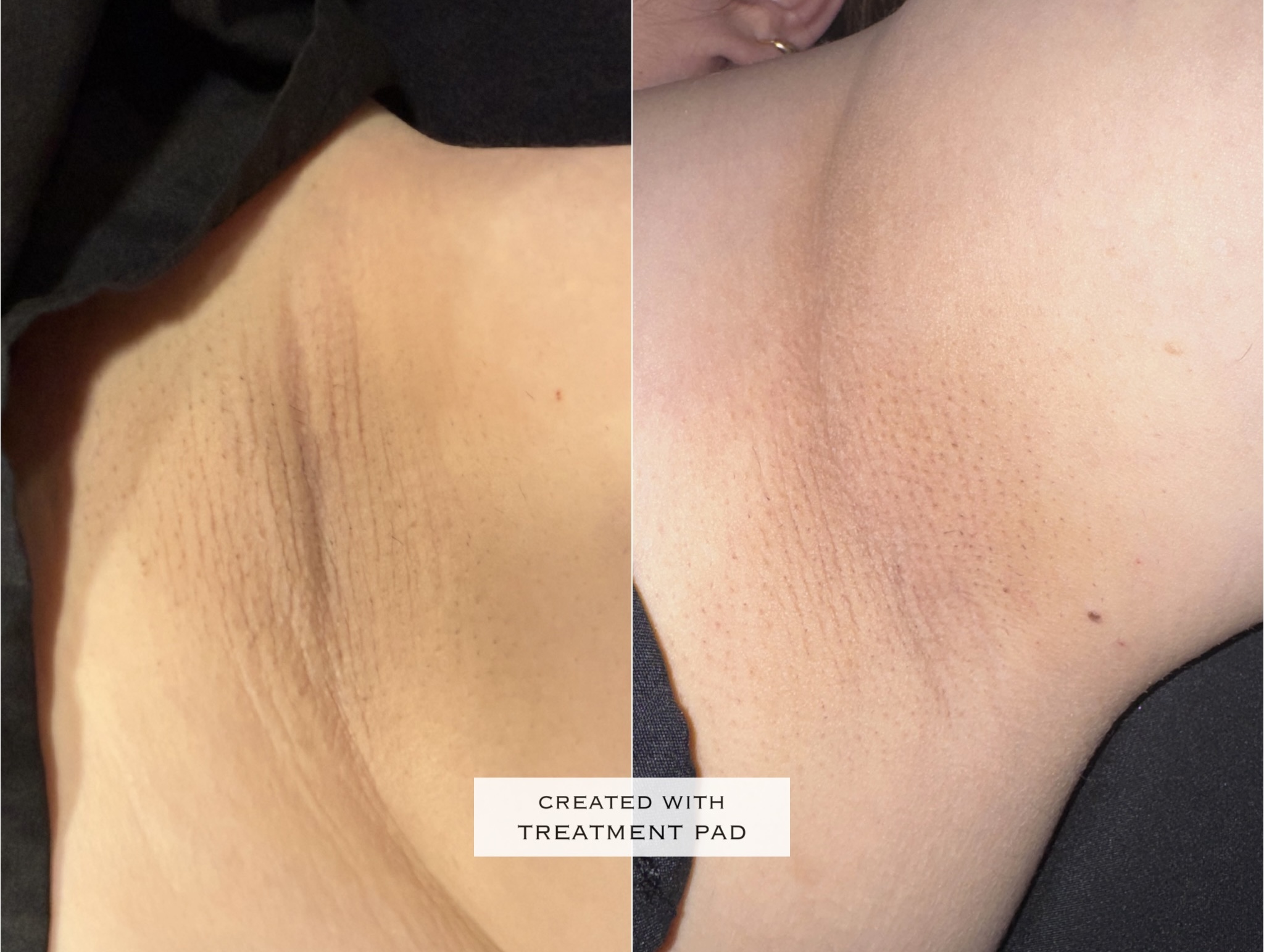 Laser hair removal before-and-after comparison from Solis