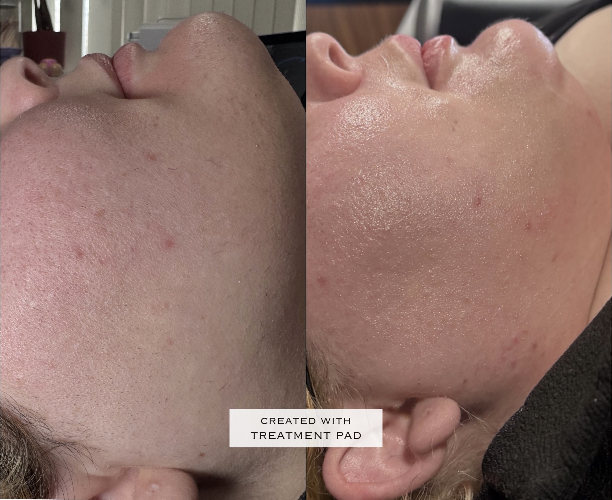 Laser hair removal before-and-after comparison from Solis