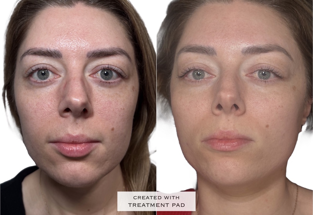 Laser / pigmentation before-and-after comparison from Solis