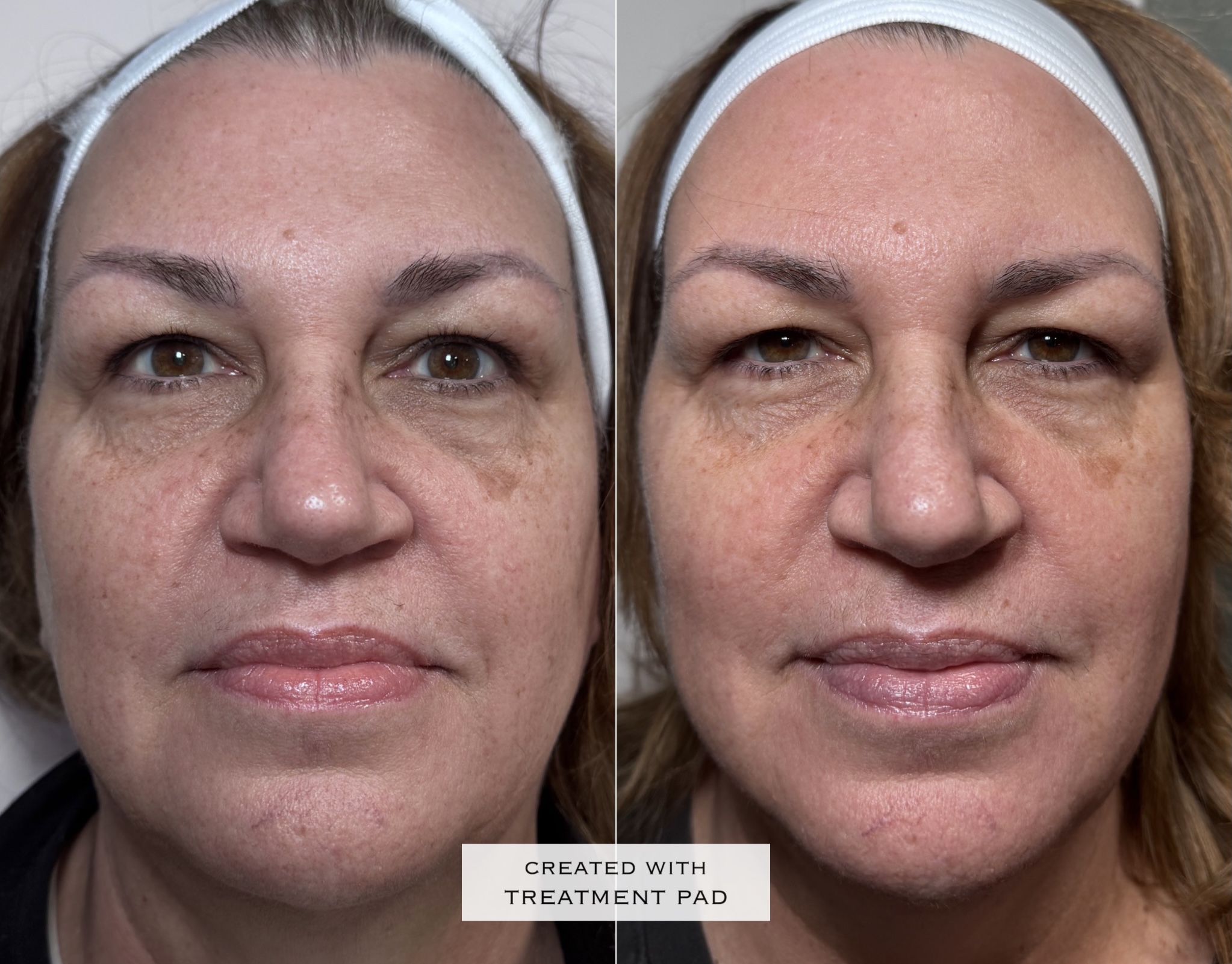Laser / pigmentation before-and-after comparison from Solis