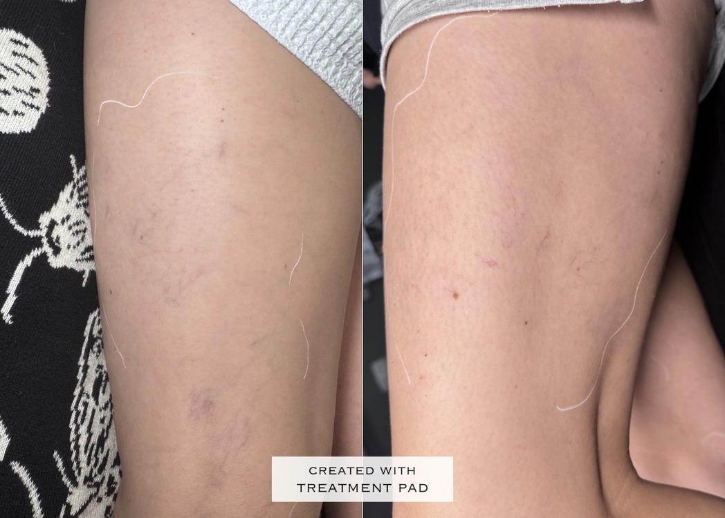 Laser / spider veins before-and-after comparison from Solis