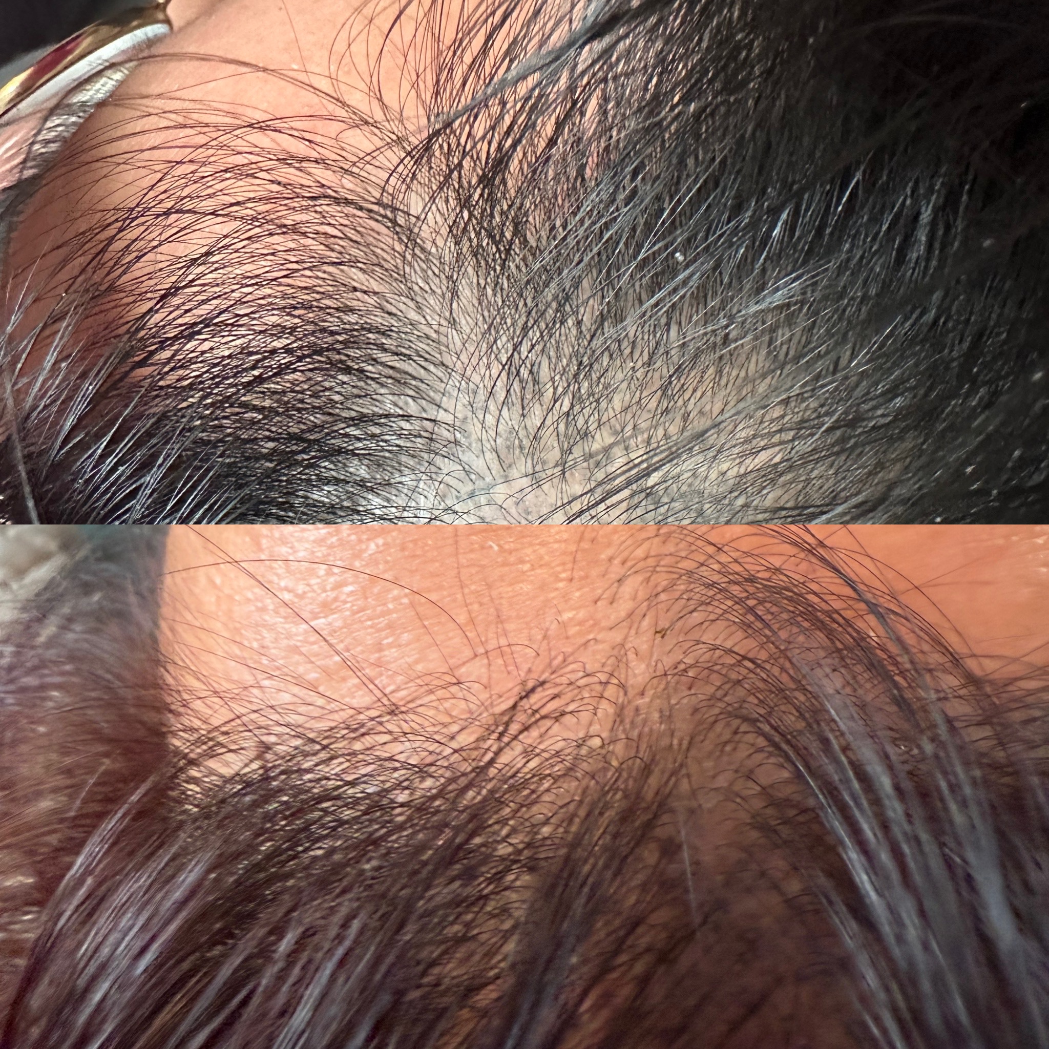 Jet Plasma / hair restoration before-and-after comparison from Solis
