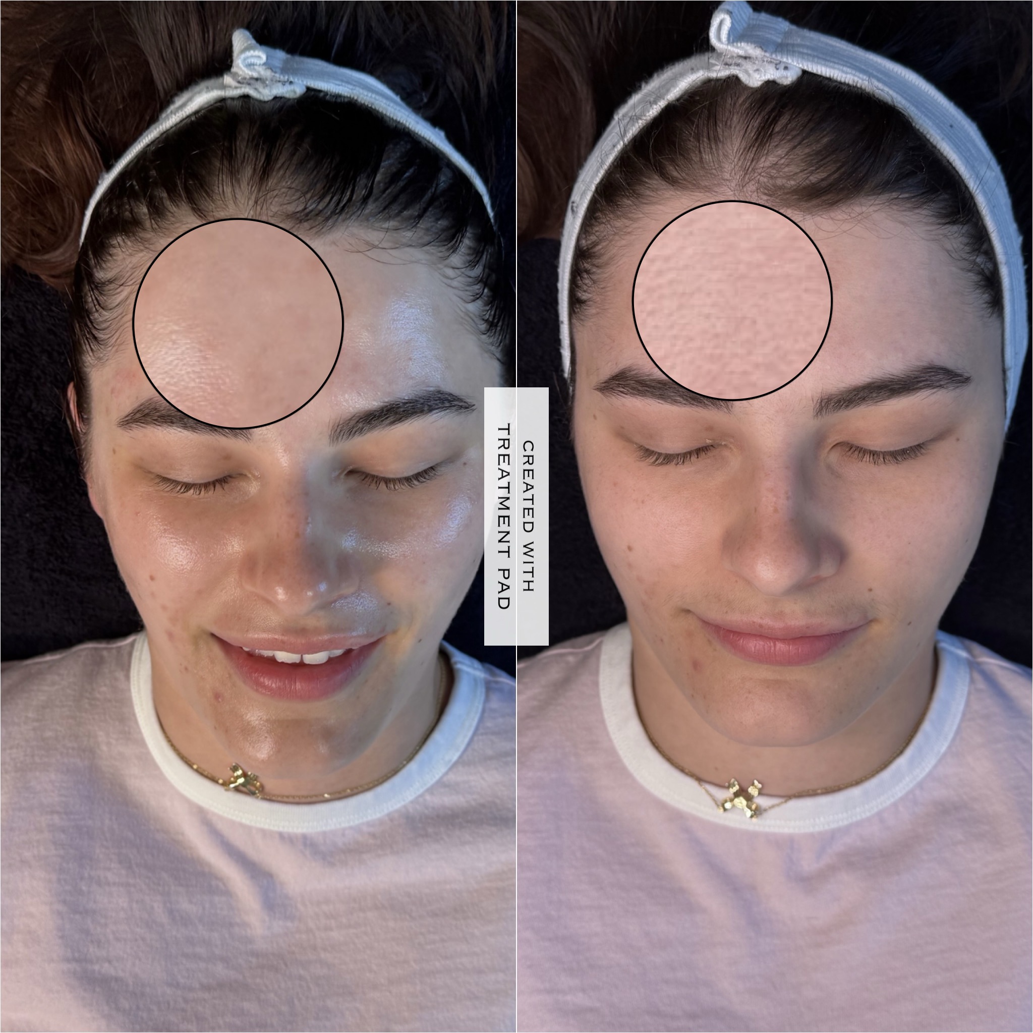 Hydrafacial before-and-after comparison with a forehead detail