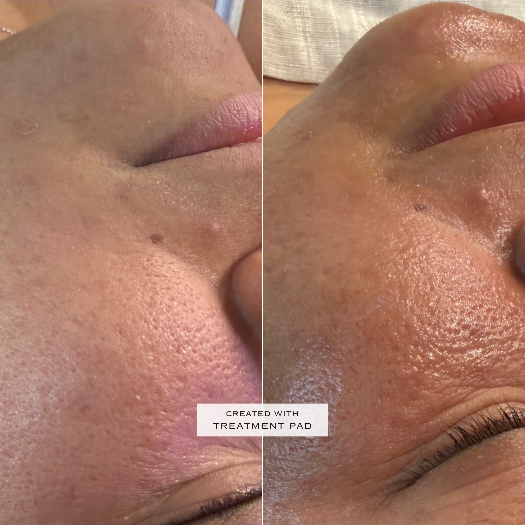 Original Solis HydraFacial & Facials treatment comparison