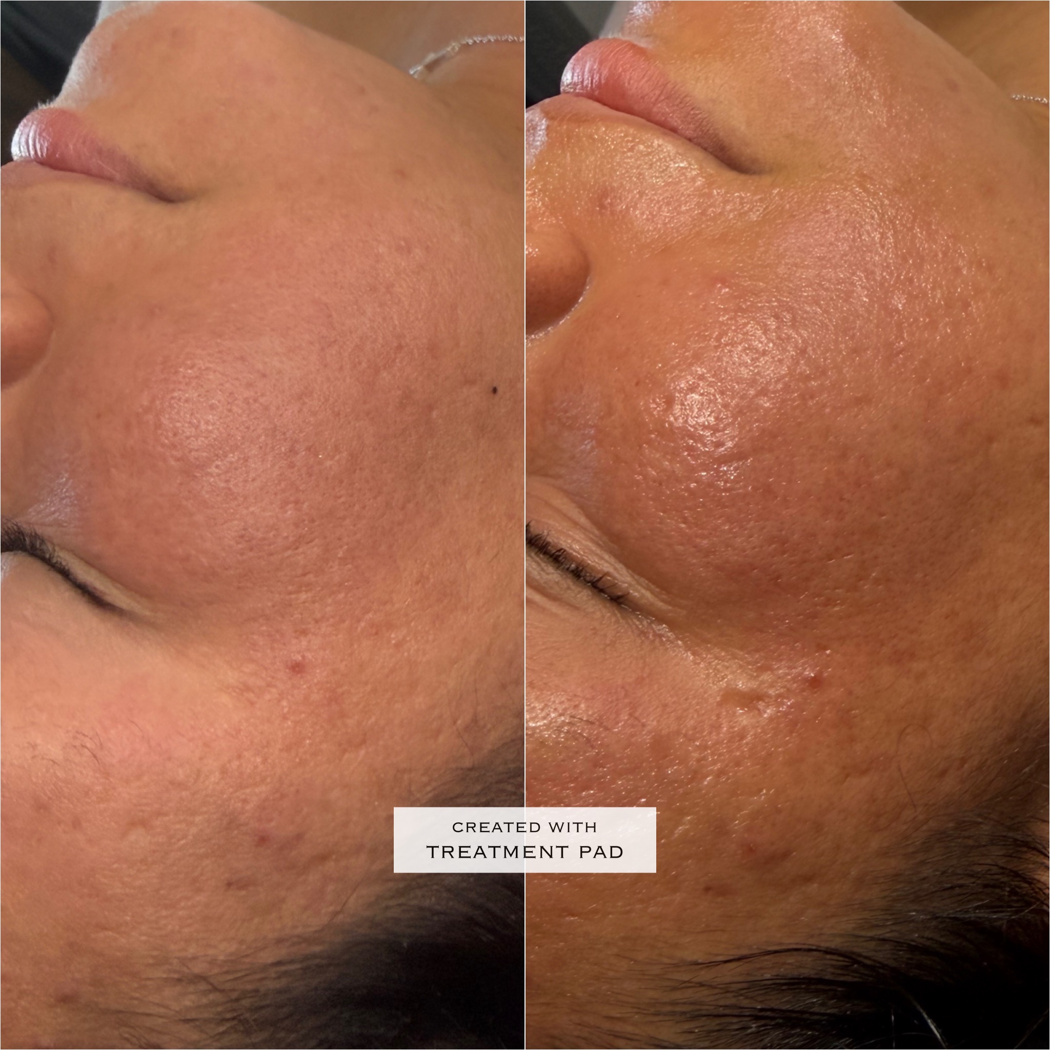 Hydrafacial before-and-after comparison from Solis