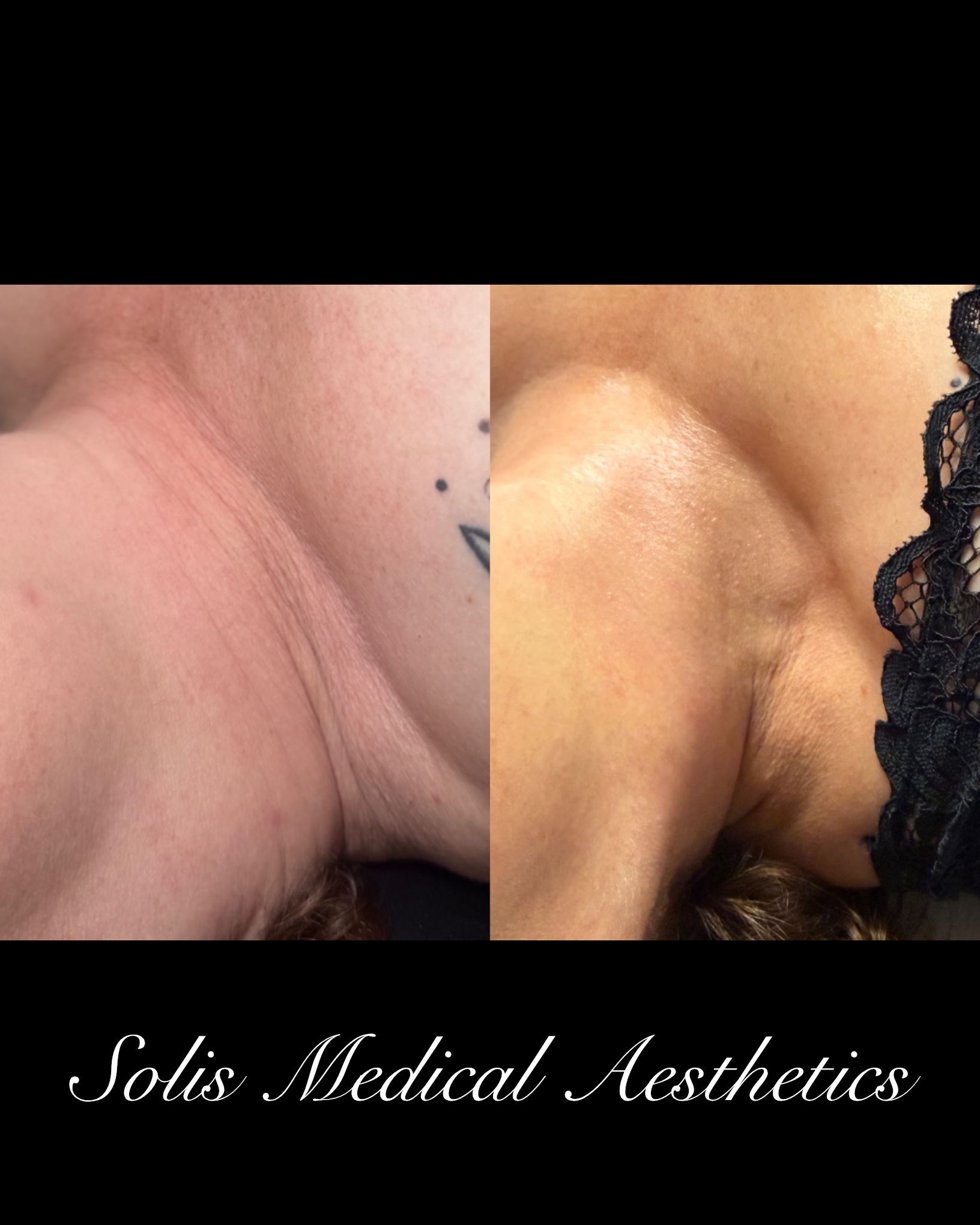 Jet Plasma before-and-after comparison from Solis