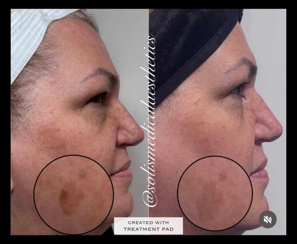Laser / pigmentation before-and-after comparison from Solis