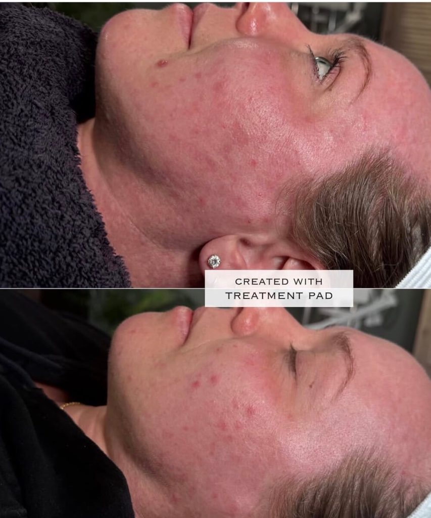 IPL / acne before-and-after comparison from Solis