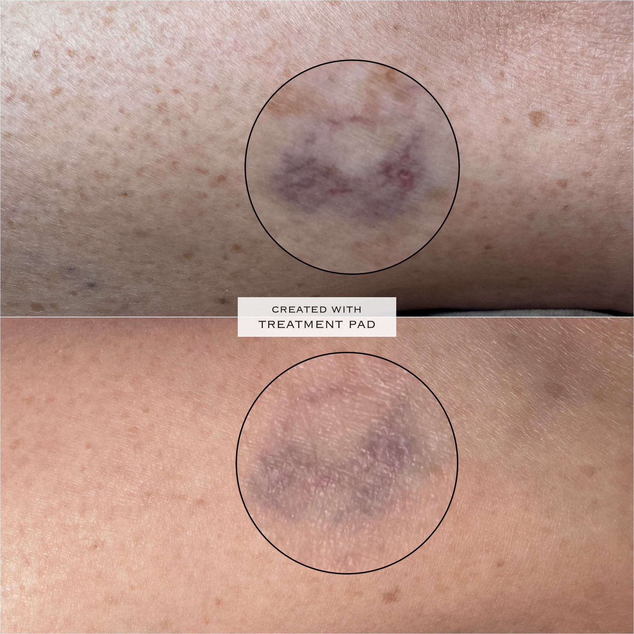 Laser / spider veins before-and-after comparison from Solis