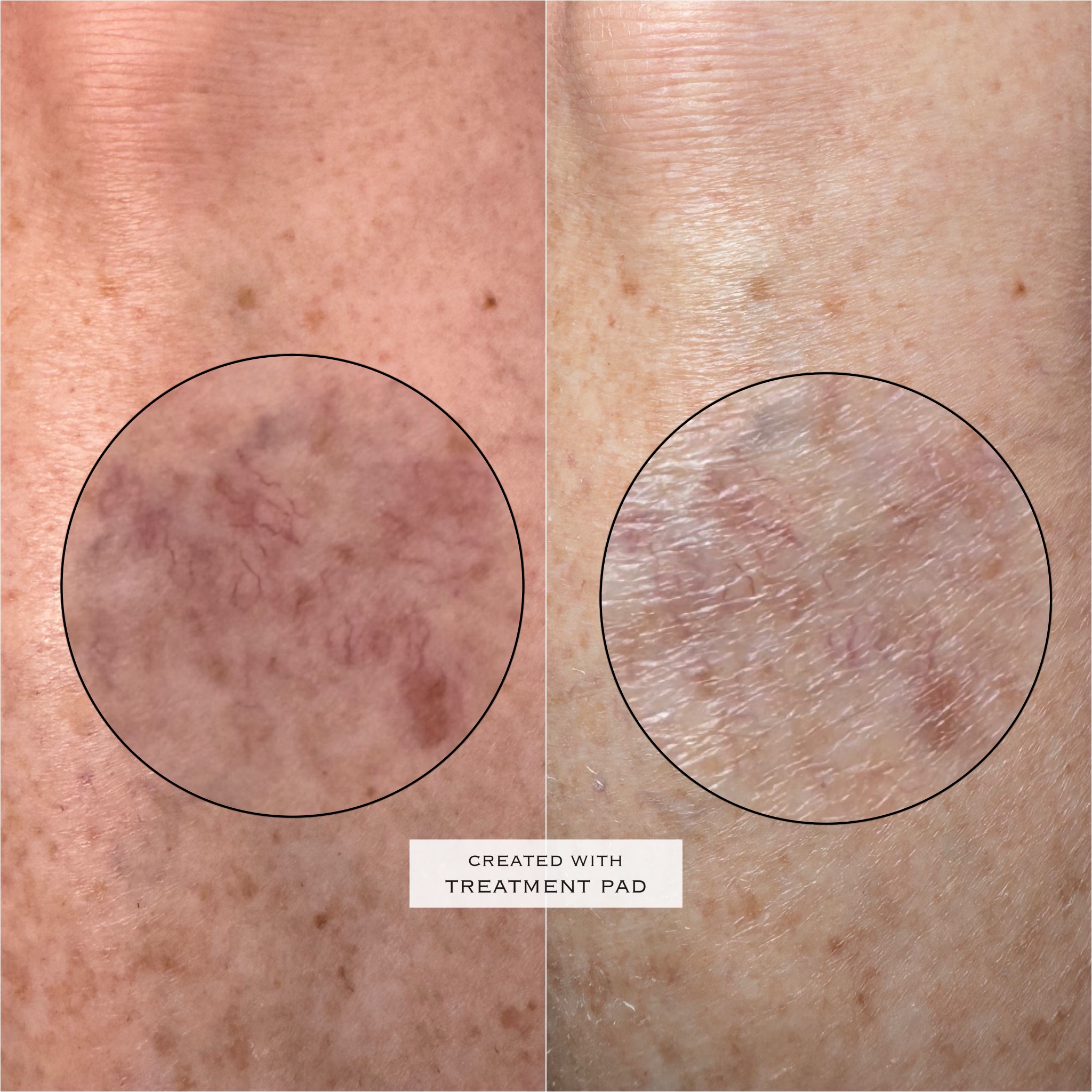 Spider-vein before-and-after comparison with original detail annotations